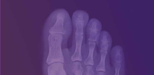 OrthoVentions Invests in MotioOV to Develop 3D Printed Implant and Instruments to Treat Joint Arthritis of the Big Toe